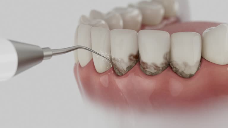 Trusted Wisdom Tooth Removal service in Lake Ripley, WI - Dentist Open Now